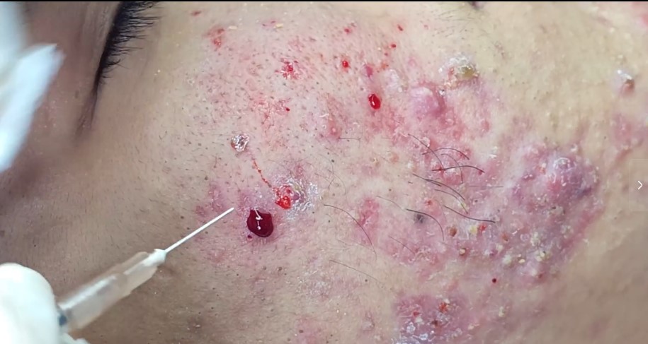 How to Restore Your Damaged Skin Barrier